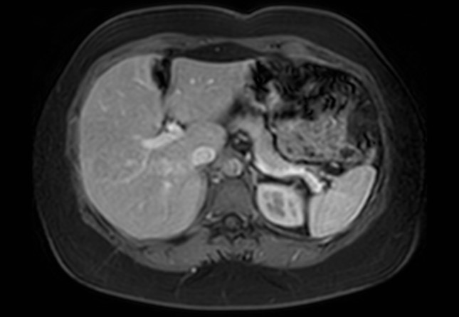 Normal liver MRI with Gadolinium (Radiopaedia 58913-66163 J 47).jpg