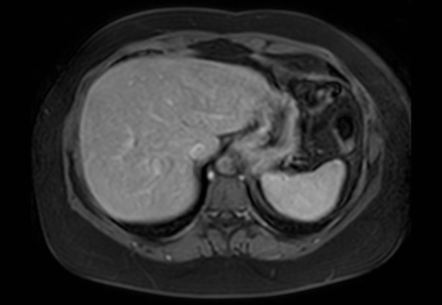 Normal liver MRI with Gadolinium (Radiopaedia 58913-66163 J 58).jpg