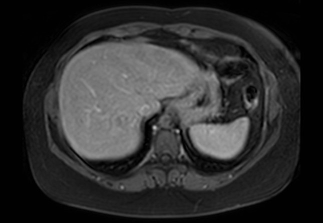 Normal liver MRI with Gadolinium (Radiopaedia 58913-66163 J 60).jpg