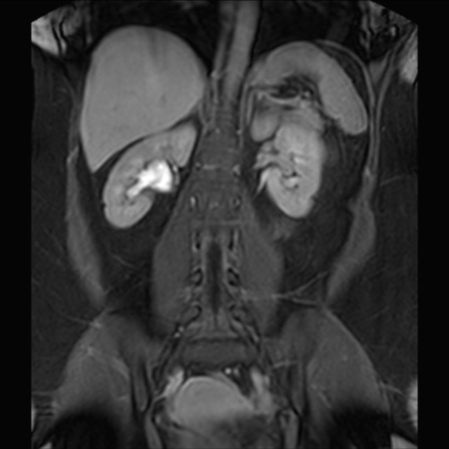 Normal liver MRI with Gadolinium (Radiopaedia 58913-66163 P 56).jpg