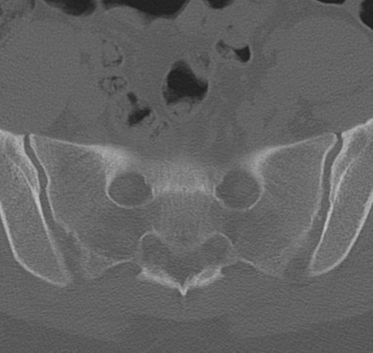 File:Normal lumbar spine CT (Radiopaedia 46533-50986 Axial bone window 74).png