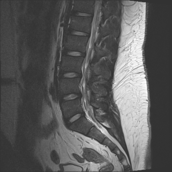 File:Normal lumbar spine MRI (Radiopaedia 47857-52609 Sagittal T2 9).jpg