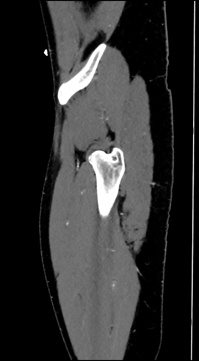 Normal pelvis CT angiogram (Radiopaedia 84966-100481 C 97).jpg