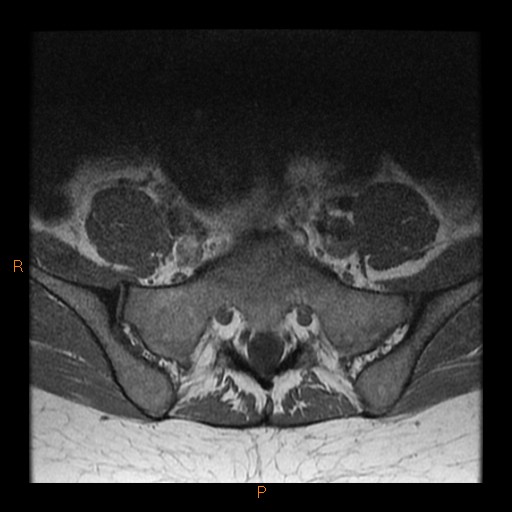 File:Normal spine MRI (Radiopaedia 77323-89408 Axial T1 27).jpg