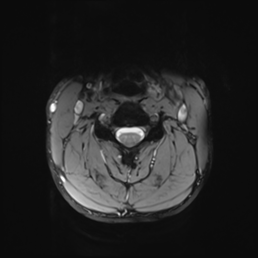 File:Normal trauma cervical spine (Radiopaedia 41017-43762 Axial T2 11).png