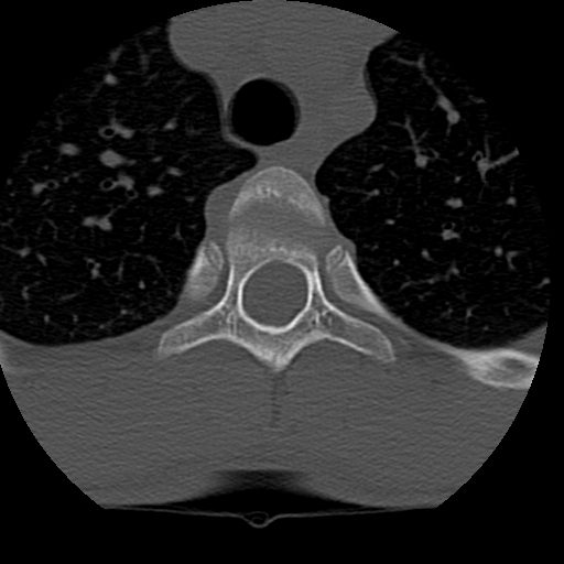 File:Normal trauma spine imaging (age 16) (Radiopaedia 45335-49358 Axial bone window 98).jpg