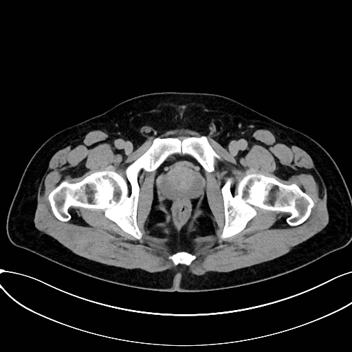 Obstructed upper pole ureter in a duplex kidney (Radiopaedia 54935-61221 Axial C+ delayed 113).jpg
