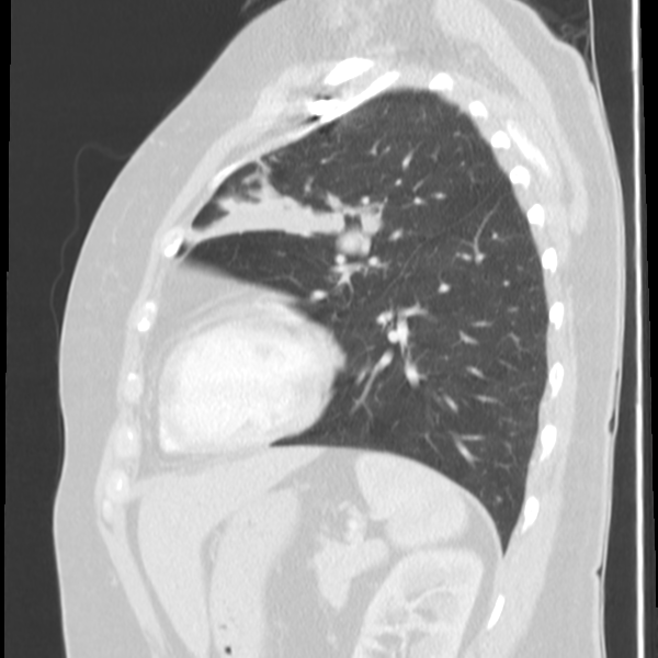Obstructing typical carcinoid causing bronchoceles (Radiopaedia 50149-55476 Sagittal lung window 41).png