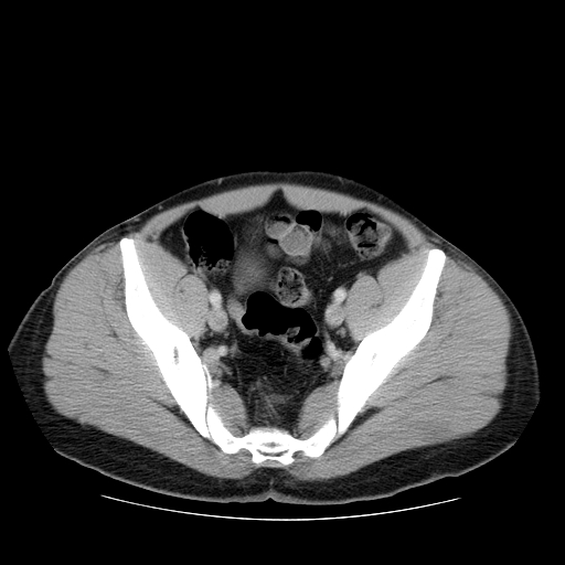 File:Obstructing ureteric calculus (Radiopaedia 18615-18514 B 46).jpg