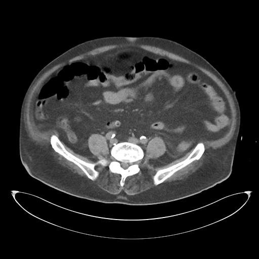 File:Obstructive pyelonephritis (Radiopaedia 46411-50844 Axial non-contrast 51).png