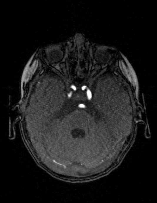 Occipital horn syndrome (Radiopaedia 14255-14129 MRA 46).jpg