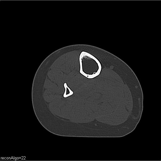 File:ACL avulsion fracture (Radiopaedia 33833-34994 Axial bone window 39).jpg