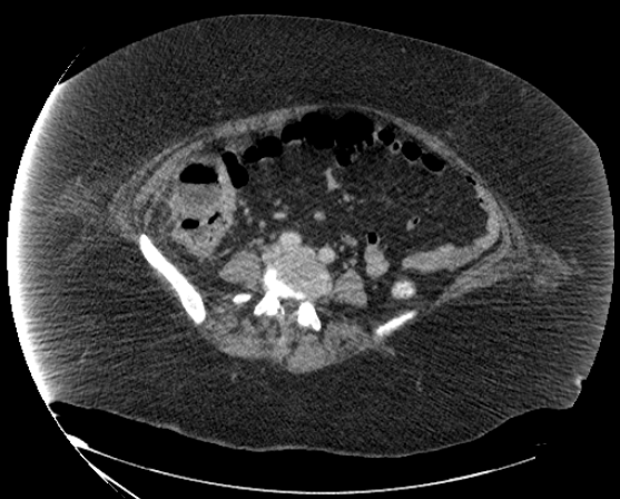 File:Abdominal abscess - pre and post percutaneous drainage (Radiopaedia 60209-67816 Axial 46).png