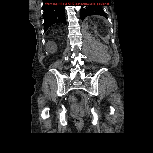 Abdominal aortic aneurysm- extremely large, ruptured (Radiopaedia 19882-19921 Coronal C+ arterial phase 78).jpg