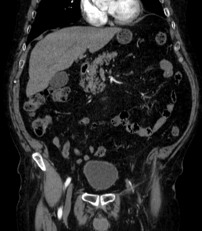 Abdominal aortic aneurysm (Radiopaedia 25855-26001 Coronal C+ arterial phase 15).jpg