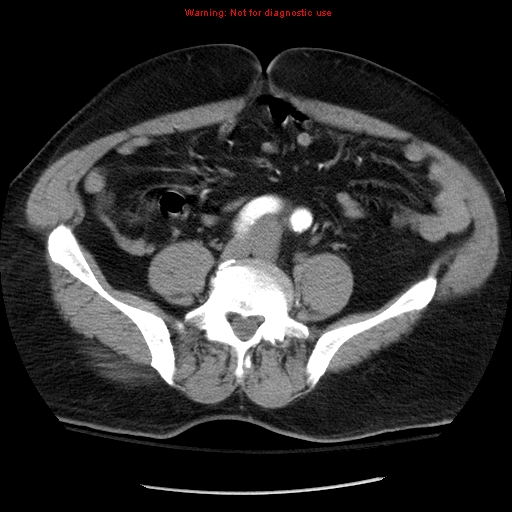 Abdominal aortic aneurysm (Radiopaedia 8190-9038 Axial C+ arterial phase 55).jpg