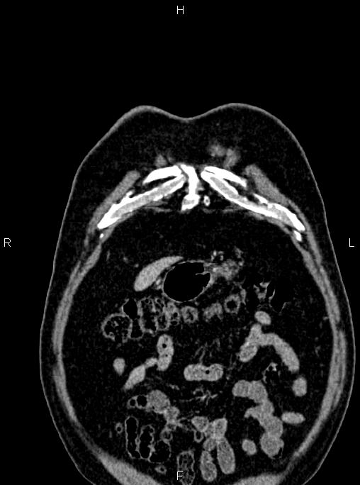 Abdominal aortic aneurysm (Radiopaedia 83094-97462 Coronal renal cortical phase 15).jpg