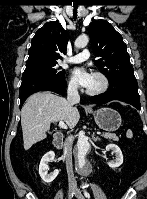 Abdominal aortic aneurysm (Radiopaedia 83094-97462 Coronal renal cortical phase 48).jpg