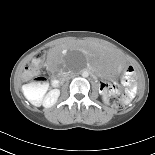 Abdominal desmoid tumor (Radiopaedia 41007-43740 Axial C+ portal venous phase 30).png