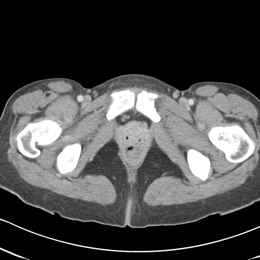 Abdominal desmoid tumor (Radiopaedia 41007-43740 Axial C+ portal venous phase 74).png