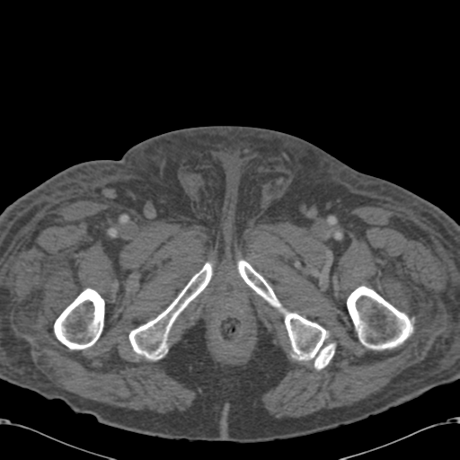 Abdominal hematoma (Radiopaedia 33614-34715 Axial C+ portal venous phase 142).png