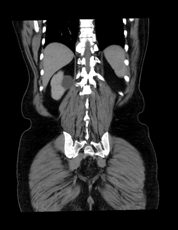 Abdominal lymphoma - with sandwich sign (Radiopaedia 53486-59492 C+ portal venous phase 10).jpg