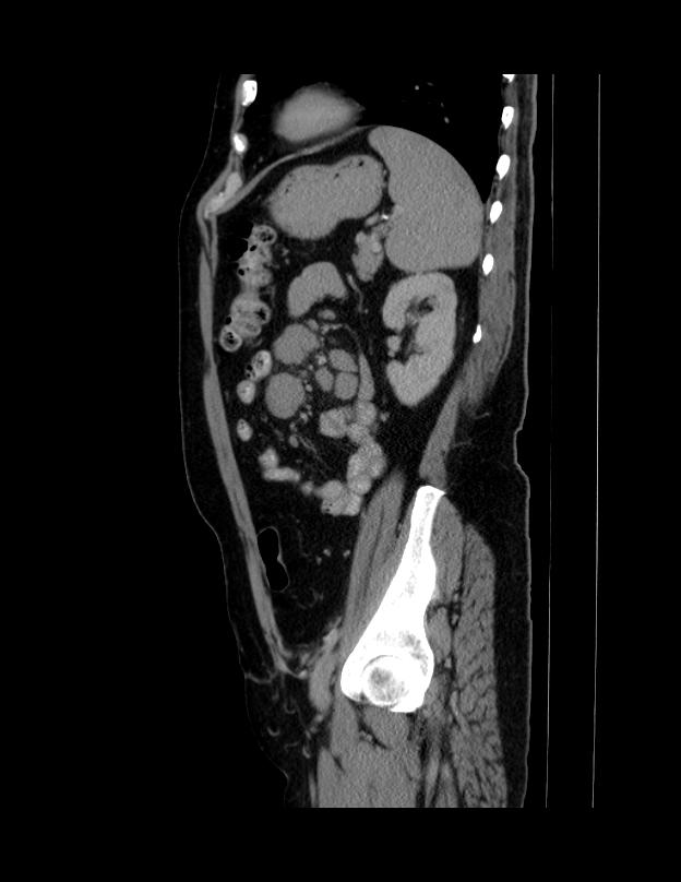 Abdominal lymphoma - with sandwich sign (Radiopaedia 53486-59492 Sagittal C+ portal venous phase 21).jpg