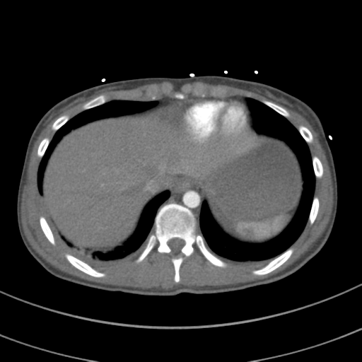 File:Abdominal multi-trauma - devascularised kidney and liver, spleen and pancreatic lacerations (Radiopaedia 34984-36486 Axial C+ arterial phase 70).png