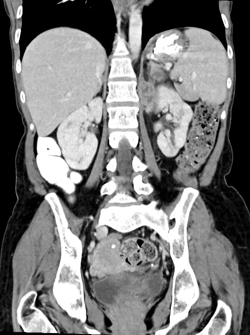Abdominal wall and retroperitoneal tuberculosis (Radiopaedia 88137-104729 Coronal C+ portal venous phase 64).jpg