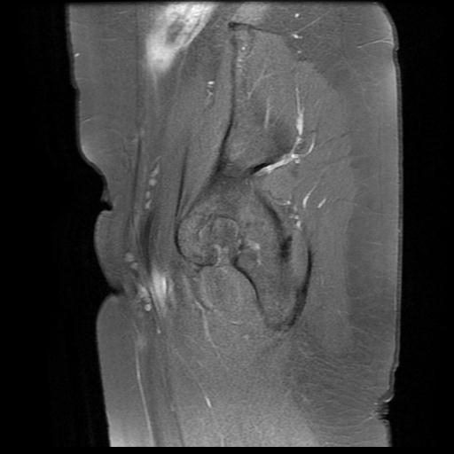 File:Abdominal wall endometriosis (Radiopaedia 83702-98847 Sagittal T1 C+ fat sat 1).jpg