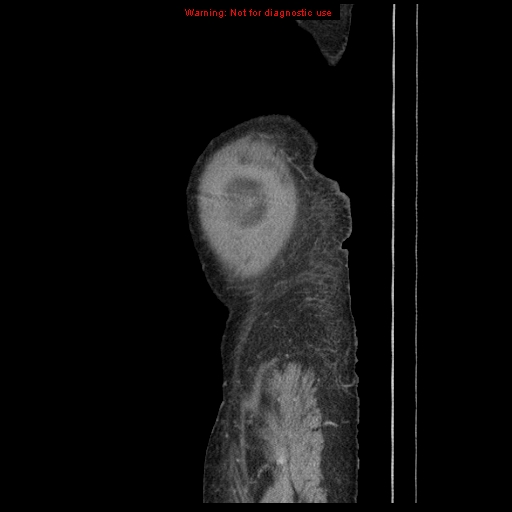 Abdominal wall hematoma (Radiopaedia 9427-10112 Sagittal C+ portal venous phase 7).jpg
