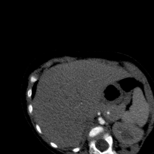 Aberrant left pulmonary artery (pulmonary sling) (Radiopaedia 42323-45435 Axial C+ CTPA 49).jpg