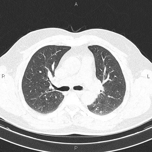 File:Aberrant right subclavian artery (Radiopaedia 87093-103354 Axial lung window 45).jpg