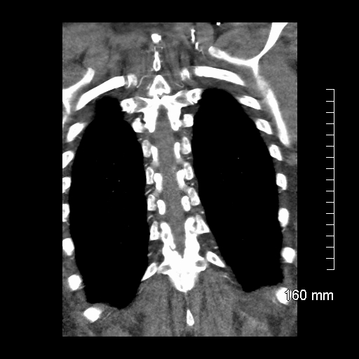 Aberrant right subclavian artery stenosis (Radiopaedia 52656-58670 B 71).jpg