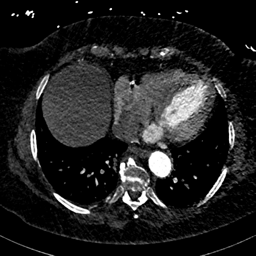 Aberrant right subclavian artery with Kommerell diverticulum (Radiopaedia 47982-52769 Axial C+ arterial phase 70).png