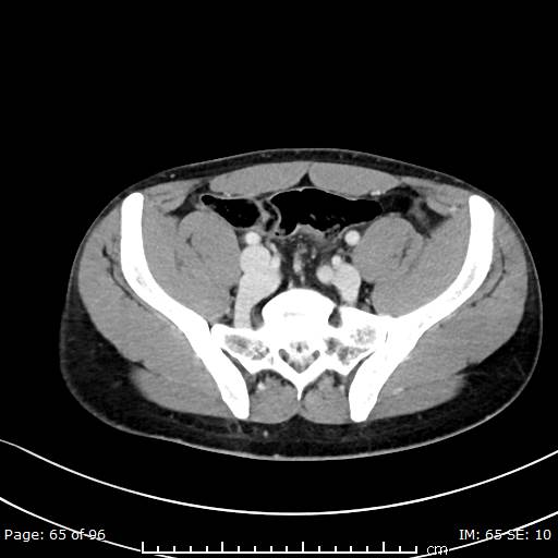 File:Absent infrarenal inferior vena cava (Radiopaedia 75804-87168 Axial C+ portal venous phase 65).jpg