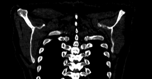 Accesory rib joint (Radiopaedia 71987-82452 Coronal bone window 74).jpg