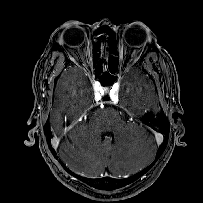 Accessory middle cerebral artery (Radiopaedia 73114-83828 Axial MRA 49).jpg
