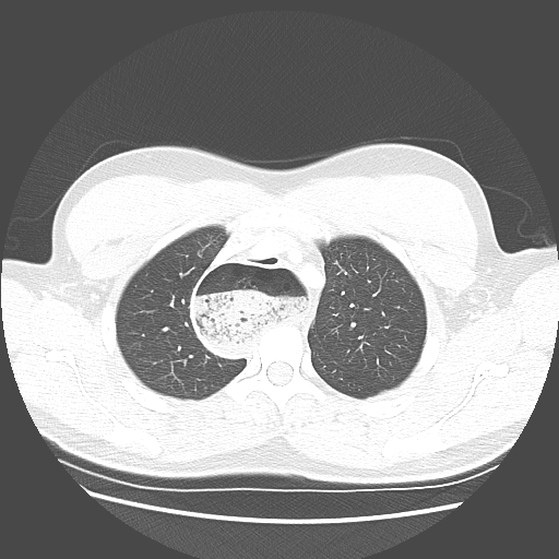 Achalasia (Radiopaedia 52507-58417 Axial lung window 14).jpg