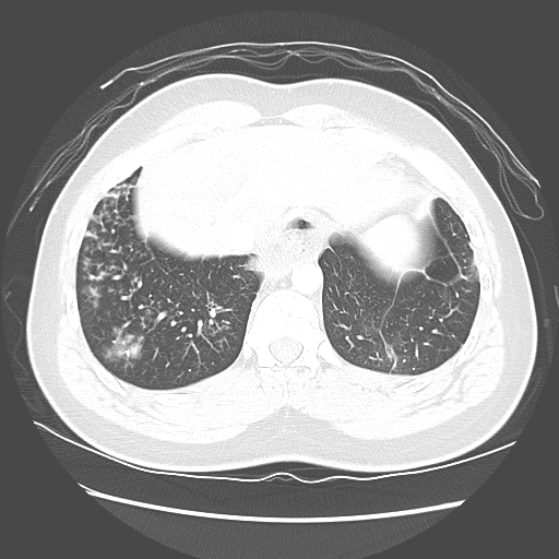 Achalasia (Radiopaedia 52507-58417 Axial lung window 53).jpg