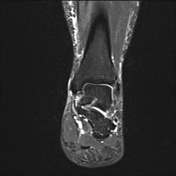 File:Achilles tendon tear (Radiopaedia 77615-89819 Coronal STIR 16).jpg