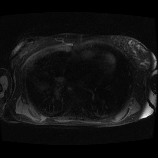 Acinar cell carcinoma of the pancreas (Radiopaedia 75442-86668 Axial late phase (~30 mins) 155).jpg