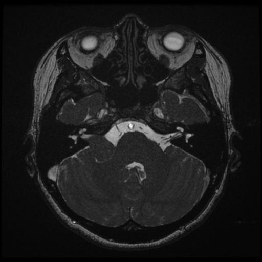 Acoustic neuroma (Radiopaedia 34049-35283 Axial 53).png