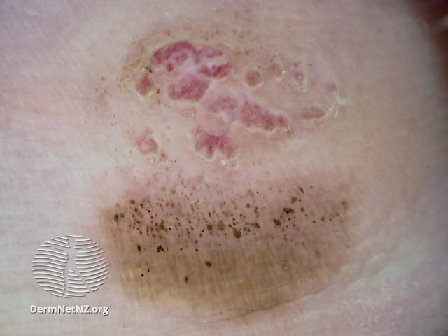 File:Acral lentiginous melanoma 2 dermoscopy (DermNet NZ alm-1-dermoscopy).jpg