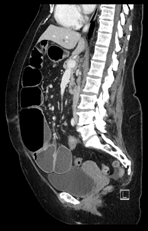 Active Crohn disease (Radiopaedia 59394-66750 Sagittal C+ portal venous phase 30).jpg