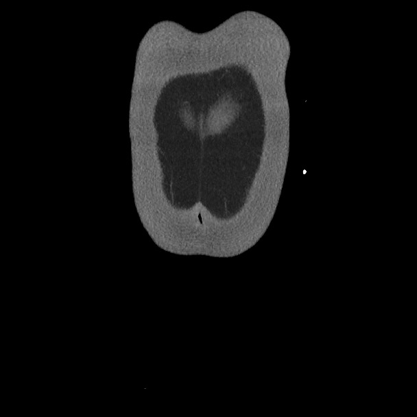 Active colonic bleed on CT (Radiopaedia 49765-55025 Coronal art MIP 6).jpg