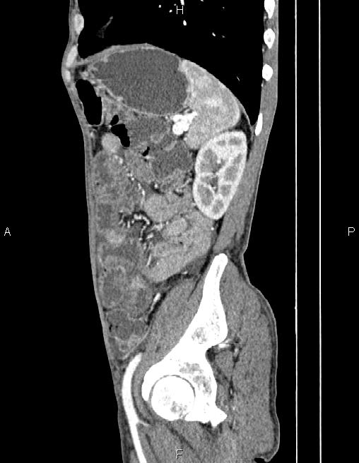 Active crohn disease (Radiopaedia 87133-103397 Sagittal C+ arterial phase 68).jpg