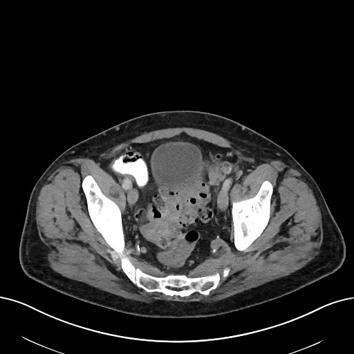 File:Active lower gastrointestinal bleeding - diverticular (Radiopaedia 61203-69106 Axial C+ portal venous phase 108).jpg