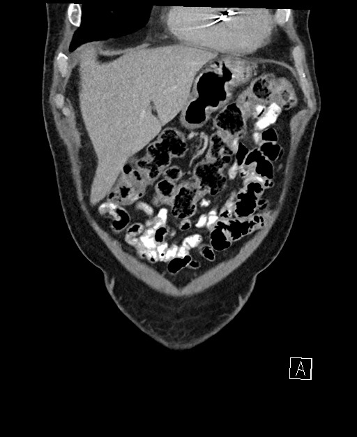 Active lower gastrointestinal bleeding - diverticular (Radiopaedia 61203-69106 Coronal C+ portal venous phase 28).jpg