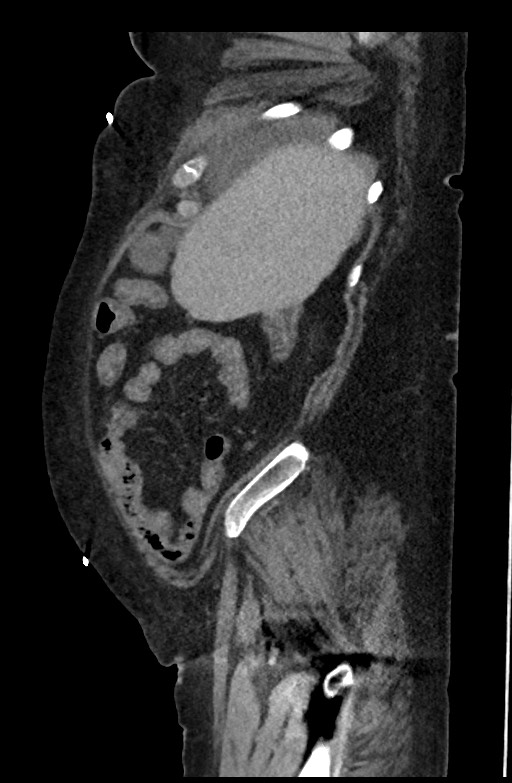 Active renal extravasation with large subcapsular and retroperitoneal hemorrhage (Radiopaedia 60975-68796 Sagittal C+ portal venous phase 180).jpg